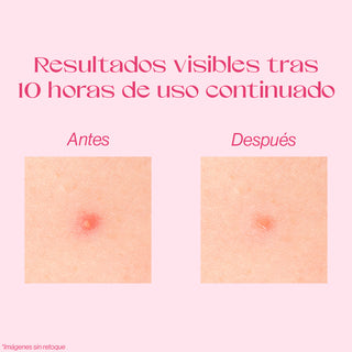 Beauty Concept Sweetheart Pimple Patches Parches Anti Imperfecciones